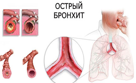 Острый бронхит у взрослых симптомы и лечение