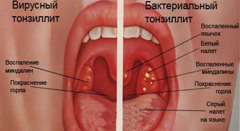 Вирусный и бактериальный тонзиллит